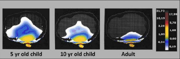 Childs radiation absorption